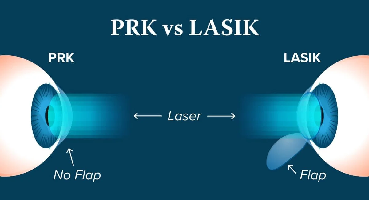 LASIK vs. PRK