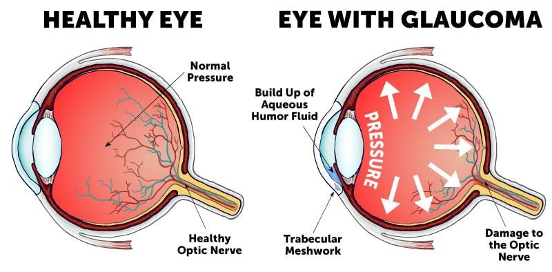 What is Glaucoma