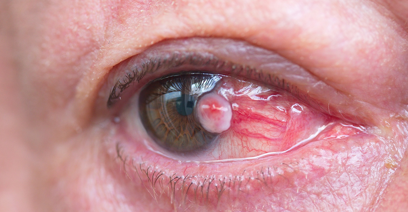 Risks of Pterygium Surgery