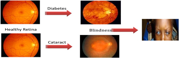 Diagnosis of Retinal Diseases