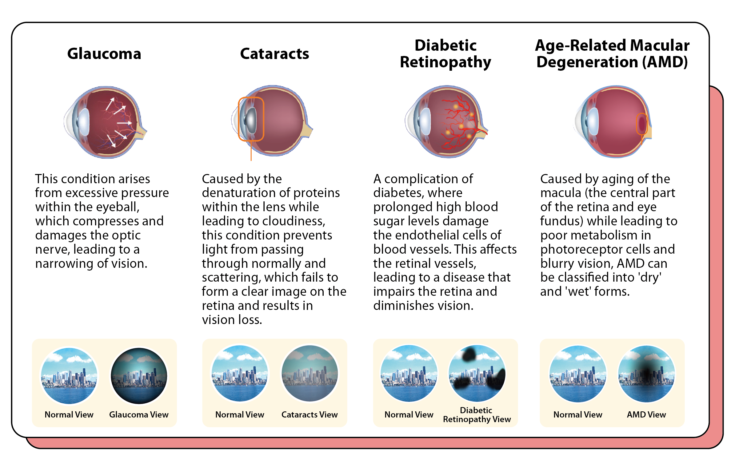 Types of Eye Conditions in Seniors