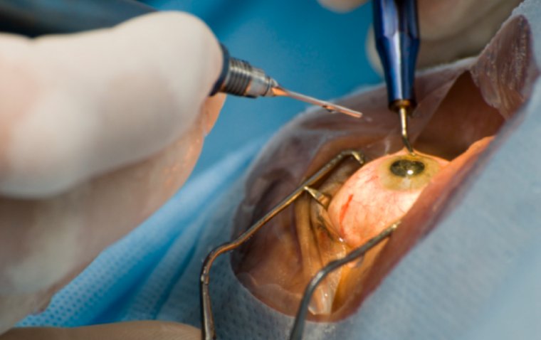 Cataract Surgery by Dr. Vishal Maniar
