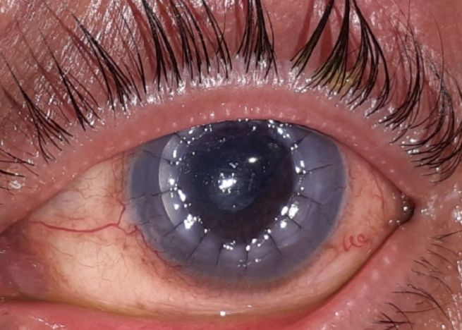 Cornea Surgery by Dr. Vishal Maniar