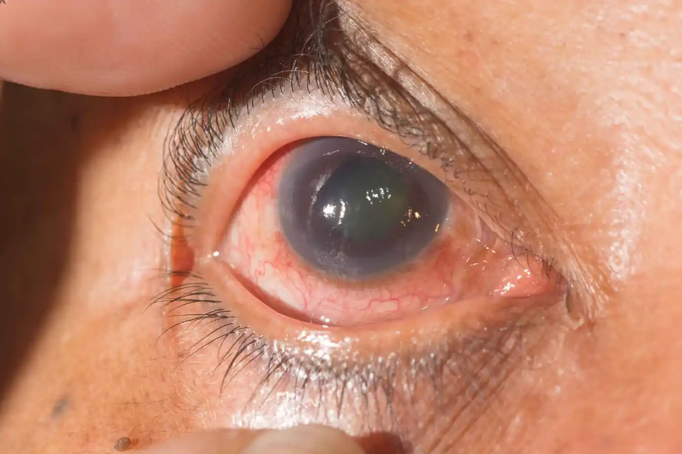 Glaucoma Surgery by Dr. Vishal Maniar