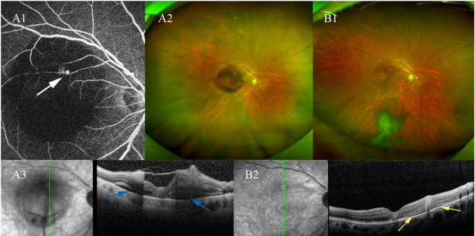 OCT Scan & YAG Laser by Dr. Vishal Maniar