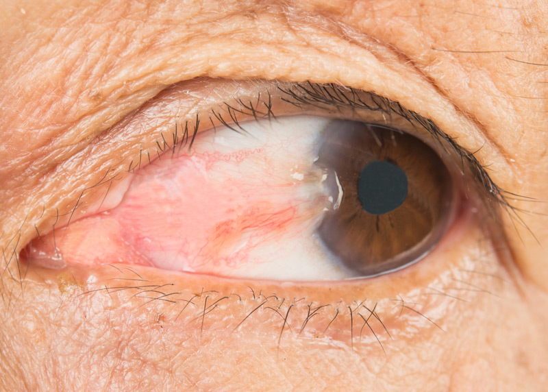 Pterygium Surgery by Dr. Vishal Maniar
